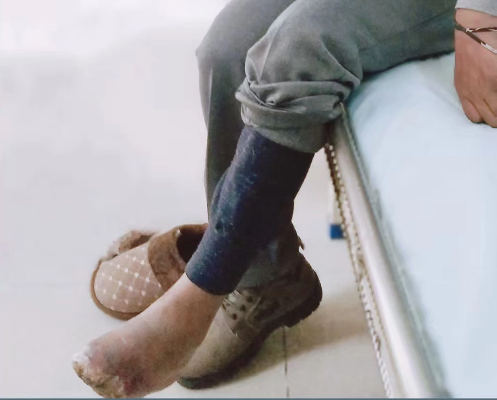 动脉硬化闭塞症康复病例