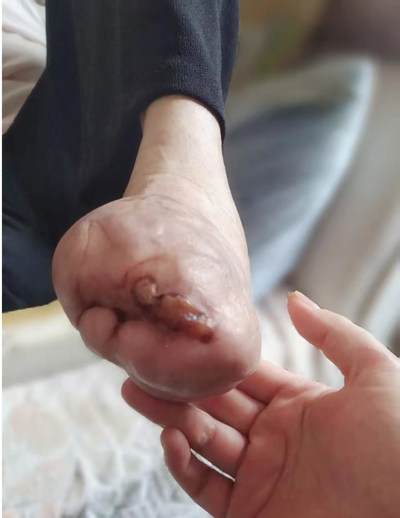 糖尿病足康复病例